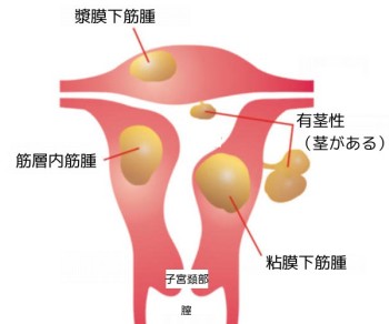 子宮筋腫は月経痛を代表的な症状とする良性の腫瘍です 子宮筋腫は月経痛を代表的な症状とする良性の腫瘍です