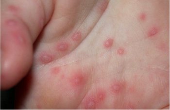 赤い発疹は梅毒の症状の特徴