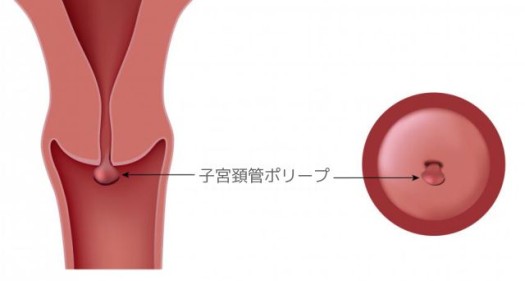 外来の摘出手術で治療できます